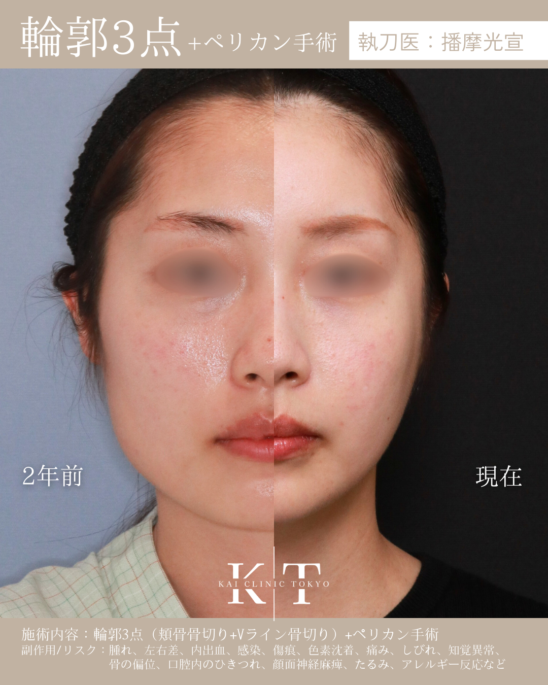 輪郭3点＋ペリカン手術