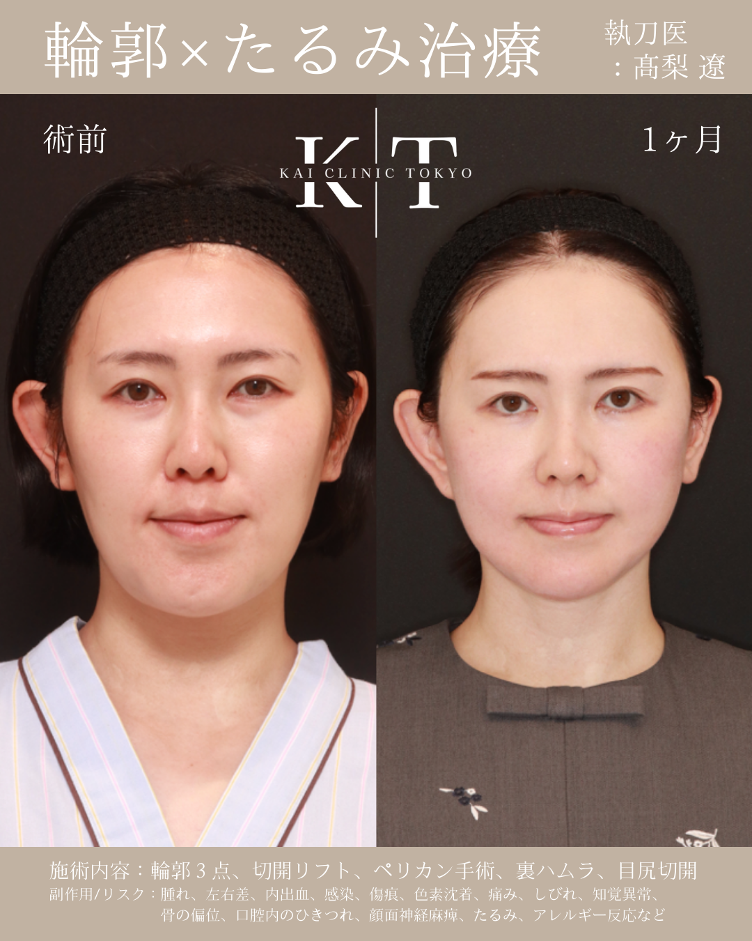 輪郭×たるみ治療