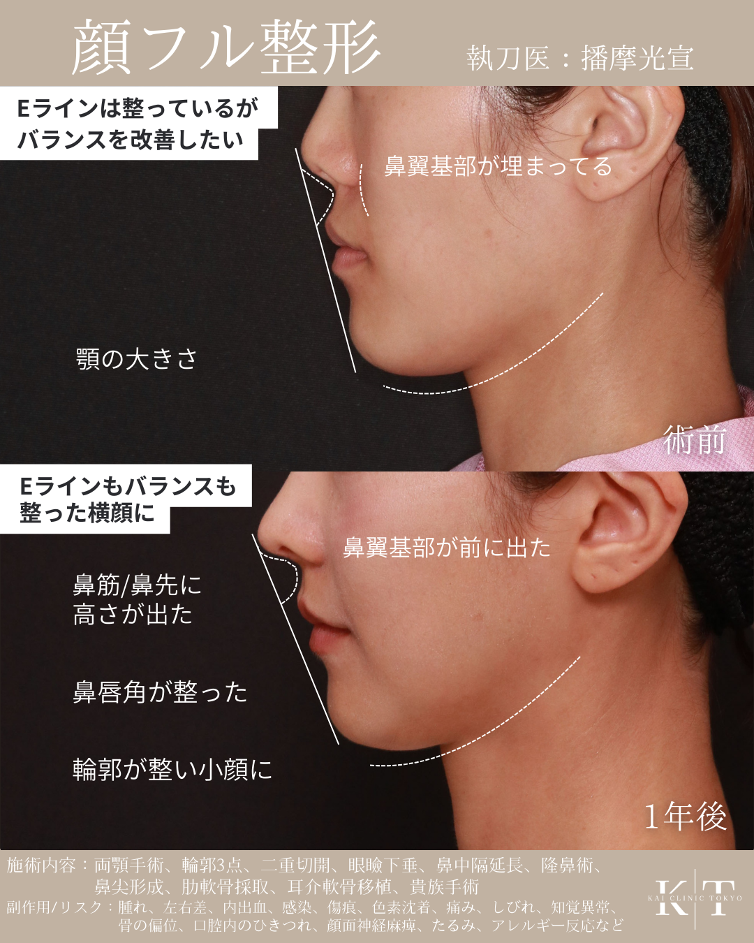 貴族手術（鼻翼基部形成）