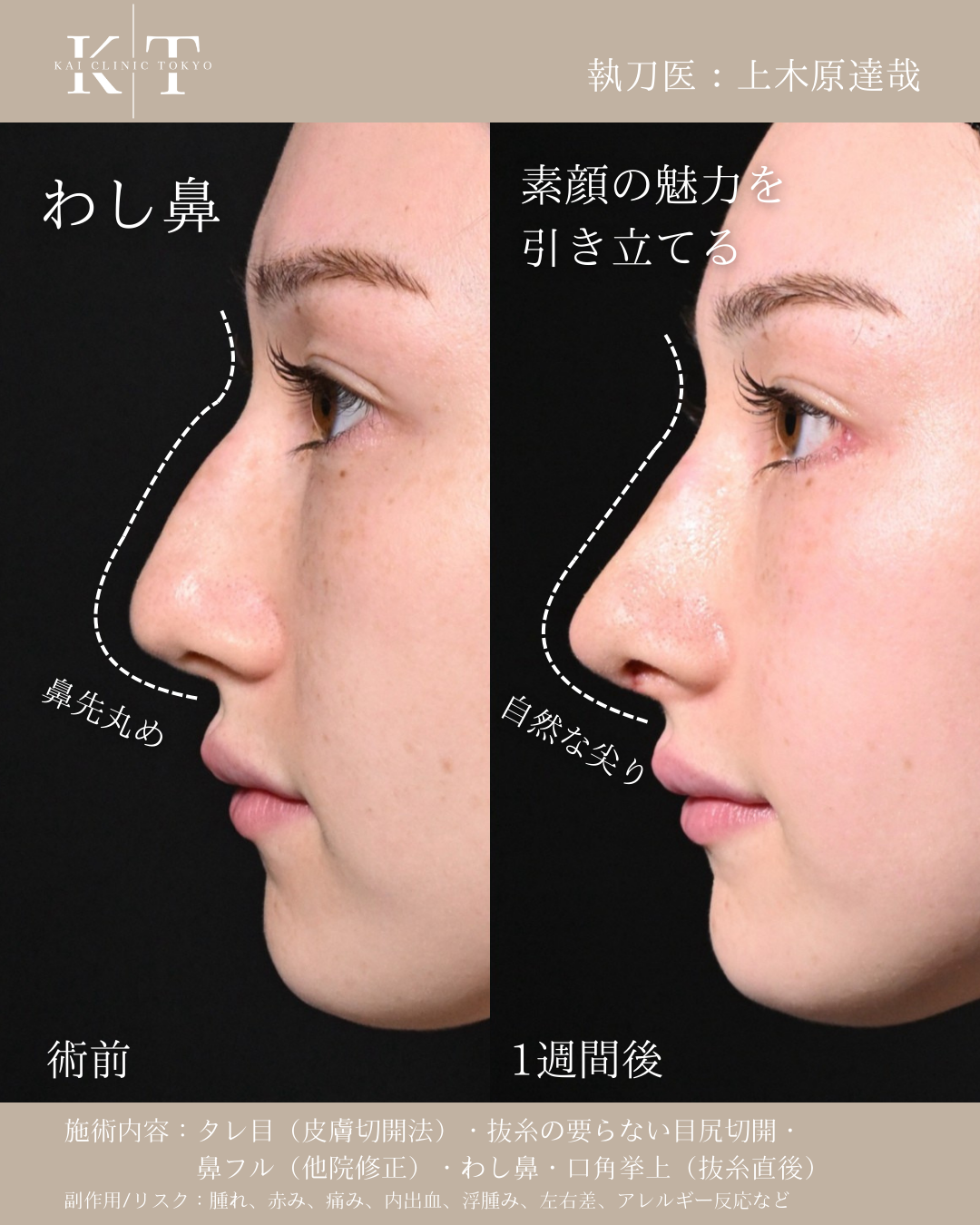 鷲鼻（ハンプ）手術