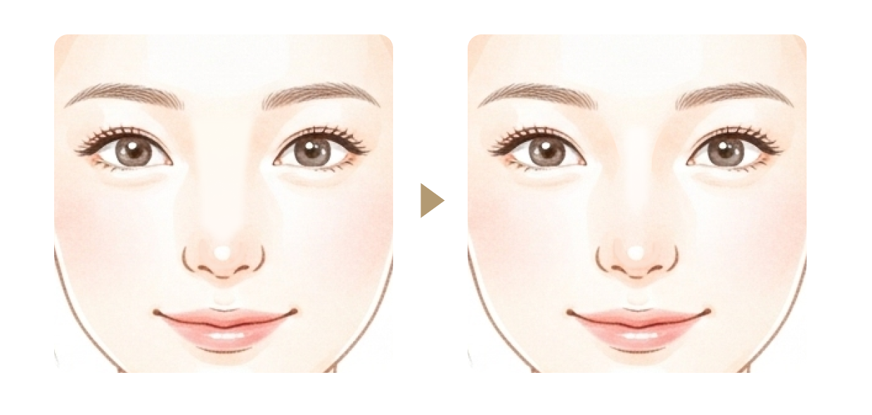 鼻骨骨切り幅寄せ術