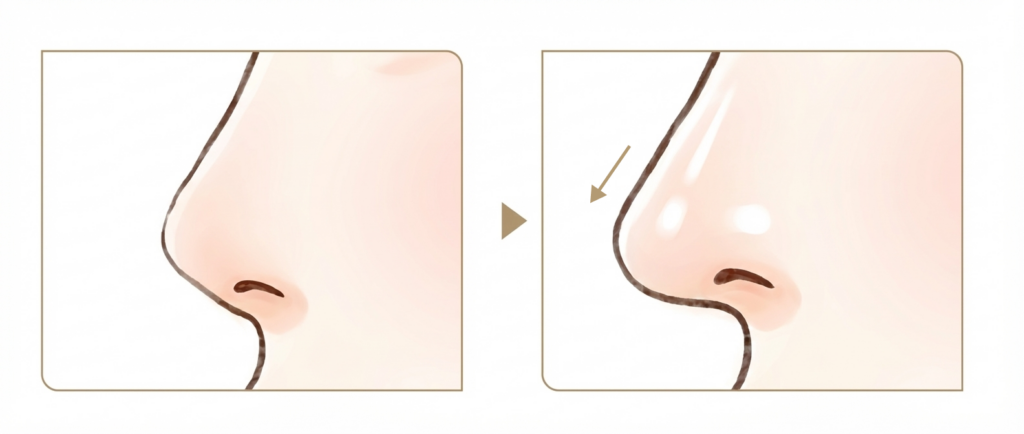 鼻中隔延長術の画像