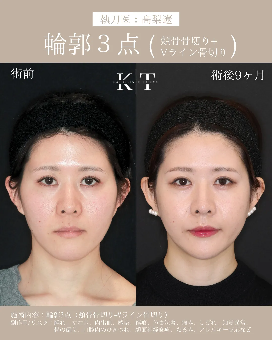 輪郭3点（頬骨骨切り+Vライン形成）