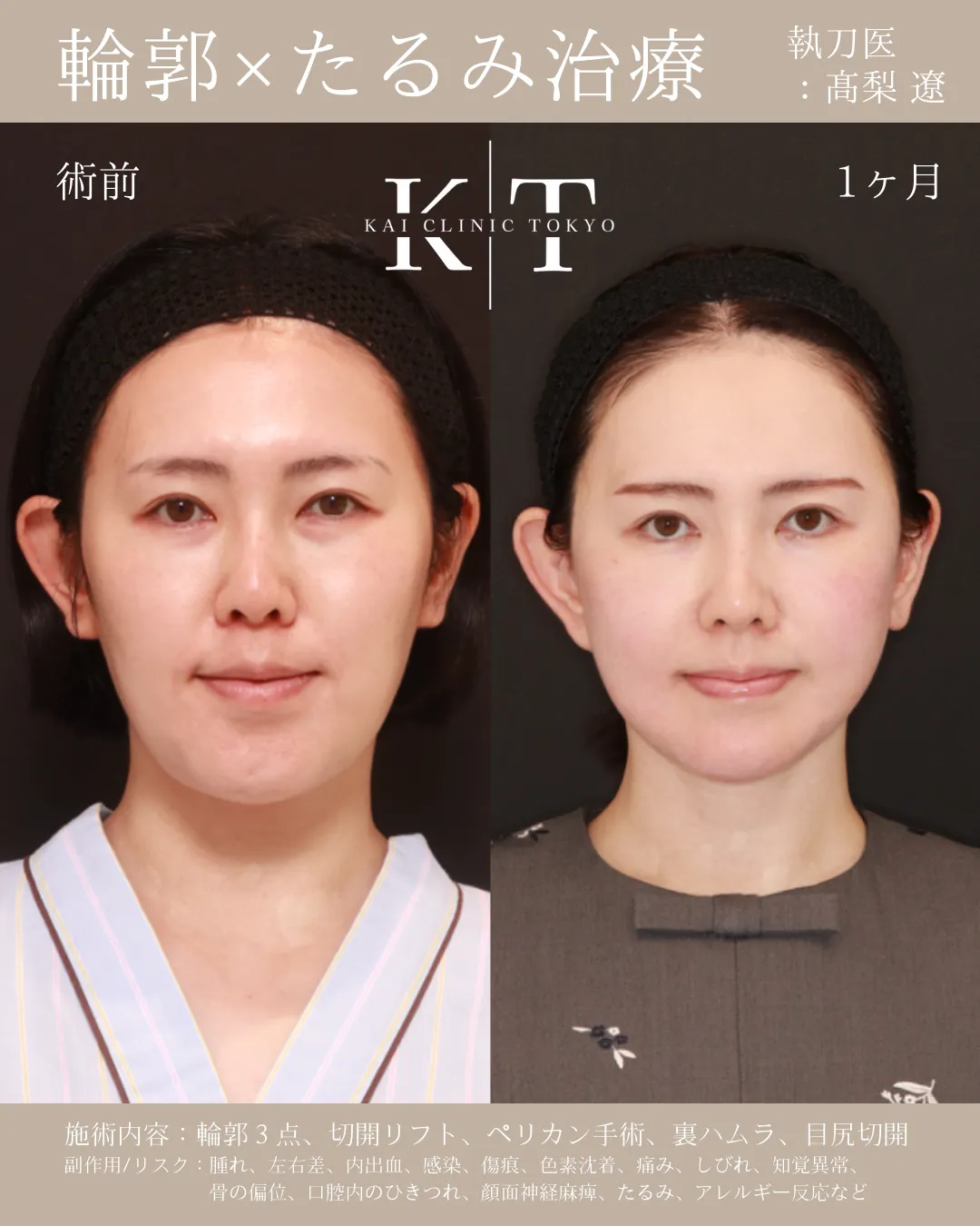 輪郭×たるみ治療