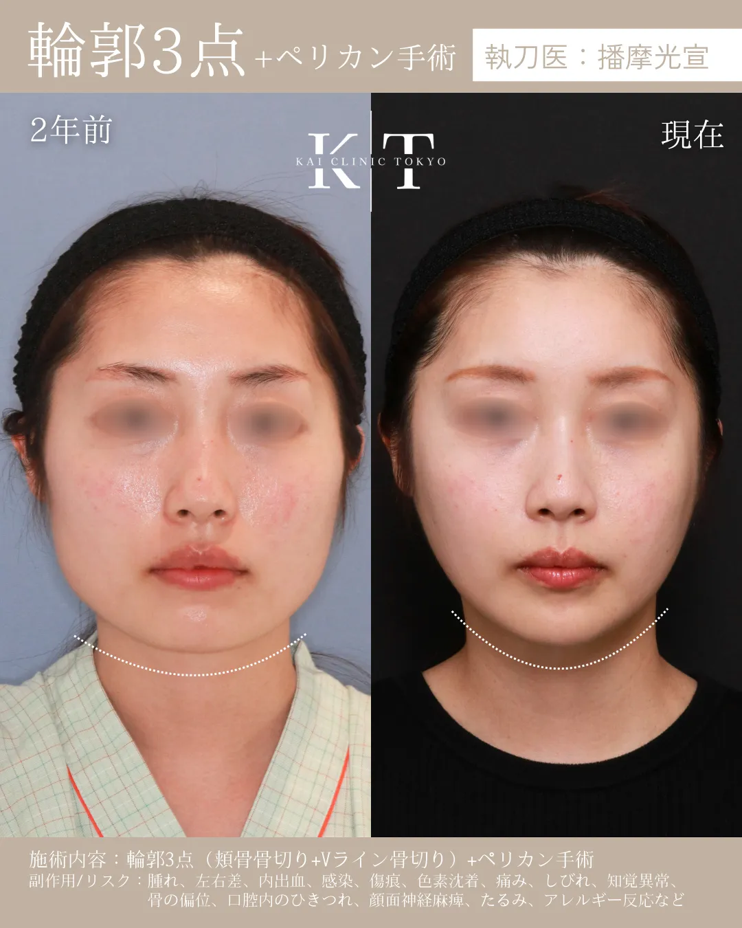 輪郭3点＋ペリカン手術