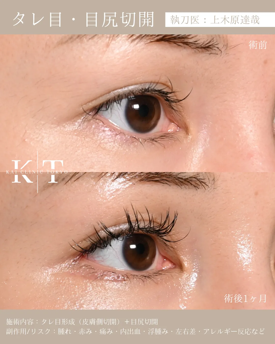 タレ目・目尻切開