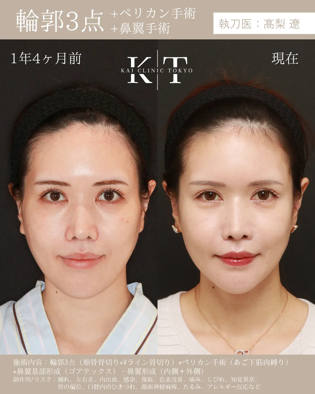 輪郭3点＋ペリカン手術＋鼻翼形成