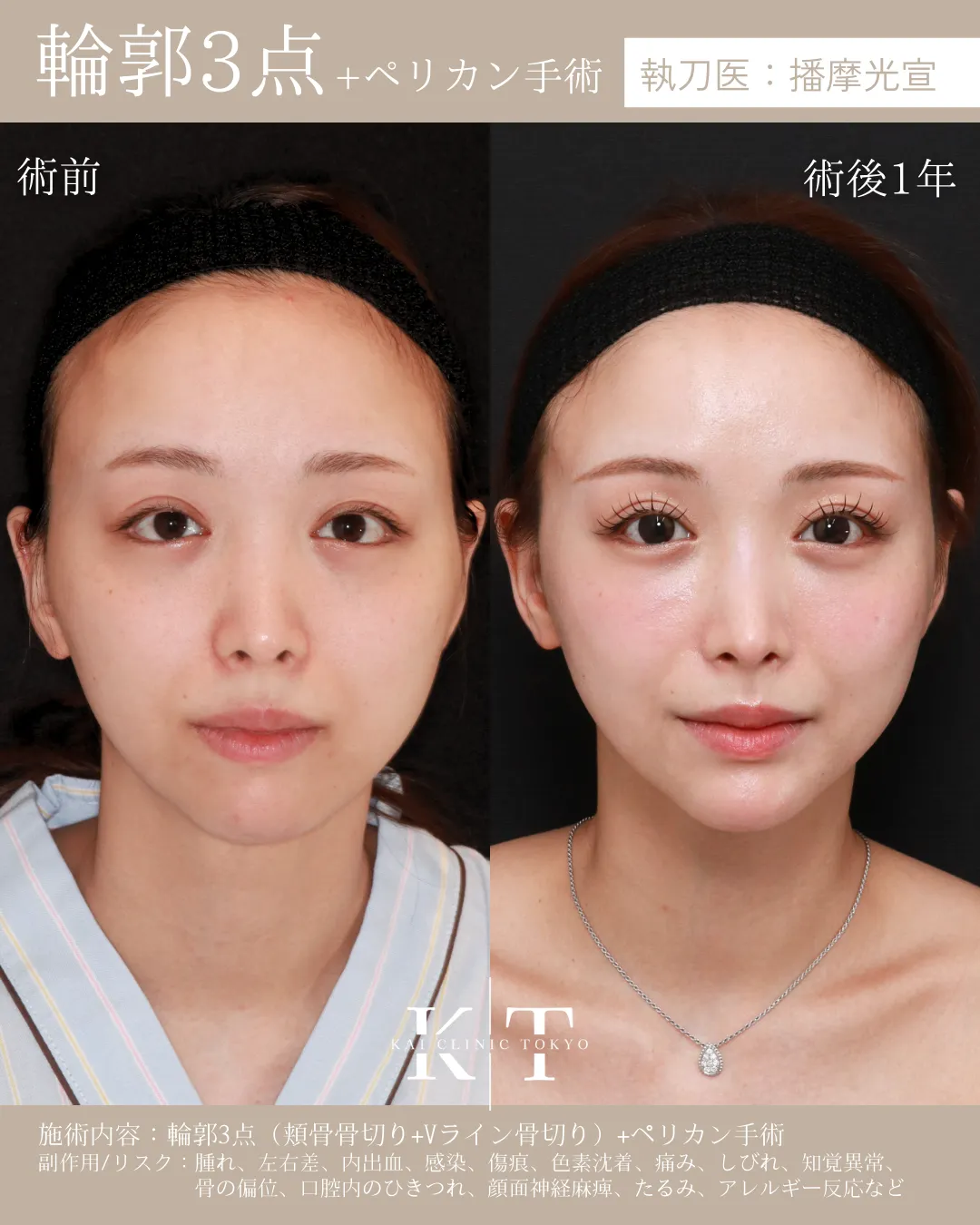 輪郭3点＋ペリカン手術