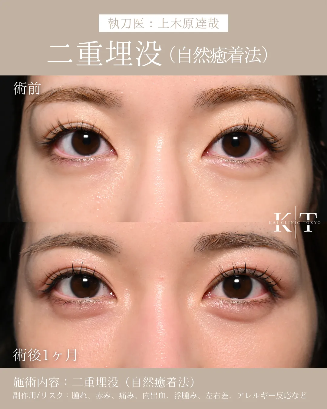 二重埋没（自然癒着法）