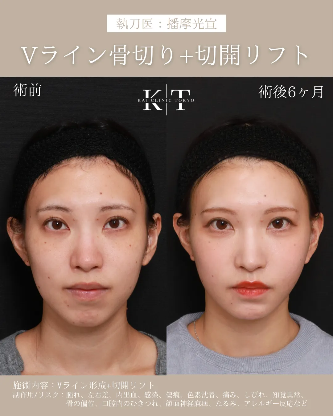 Vライン骨切り＋切開リフト