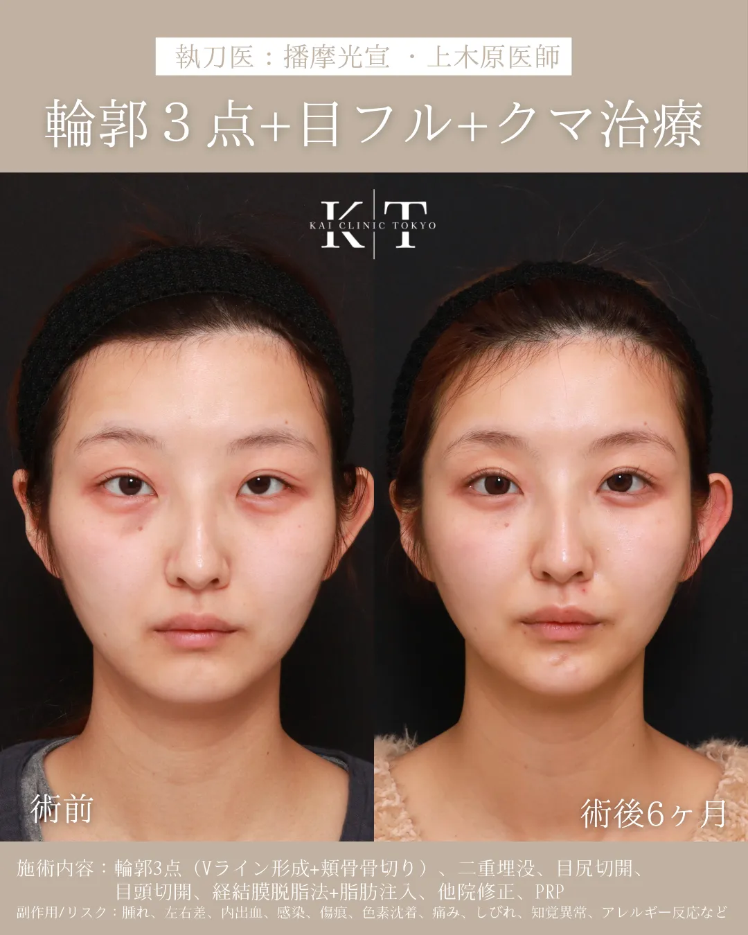 輪郭3点＋クマ治療