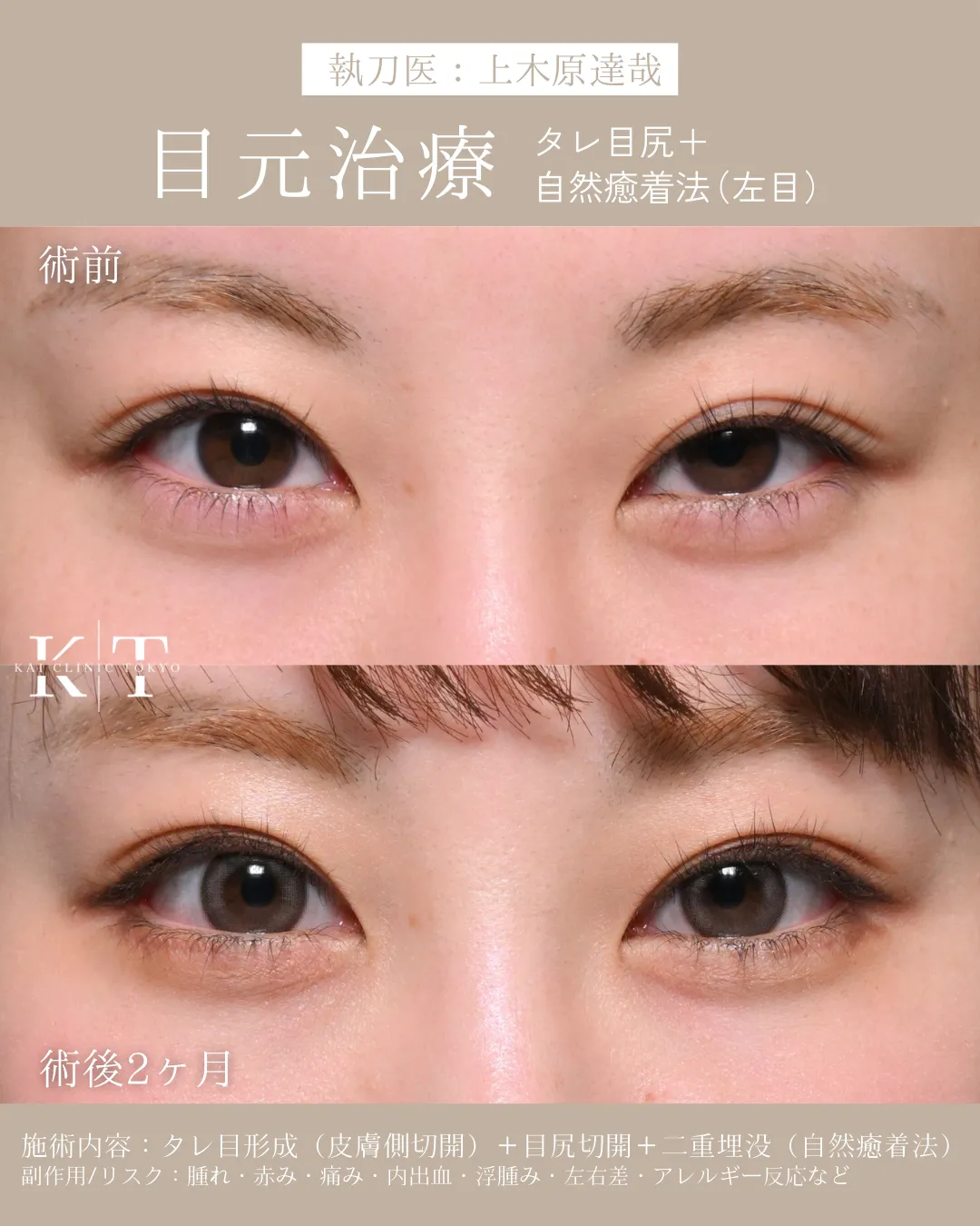 タレ目尻＋自然癒着法(左目)