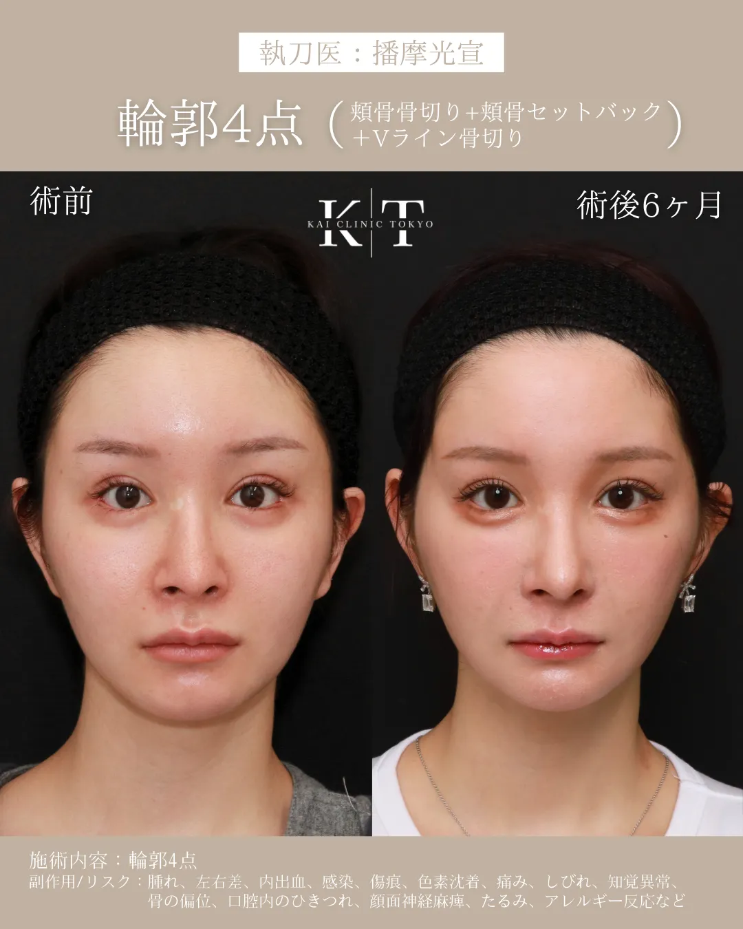 輪郭4点（頬骨セットバック+Vライン形成）