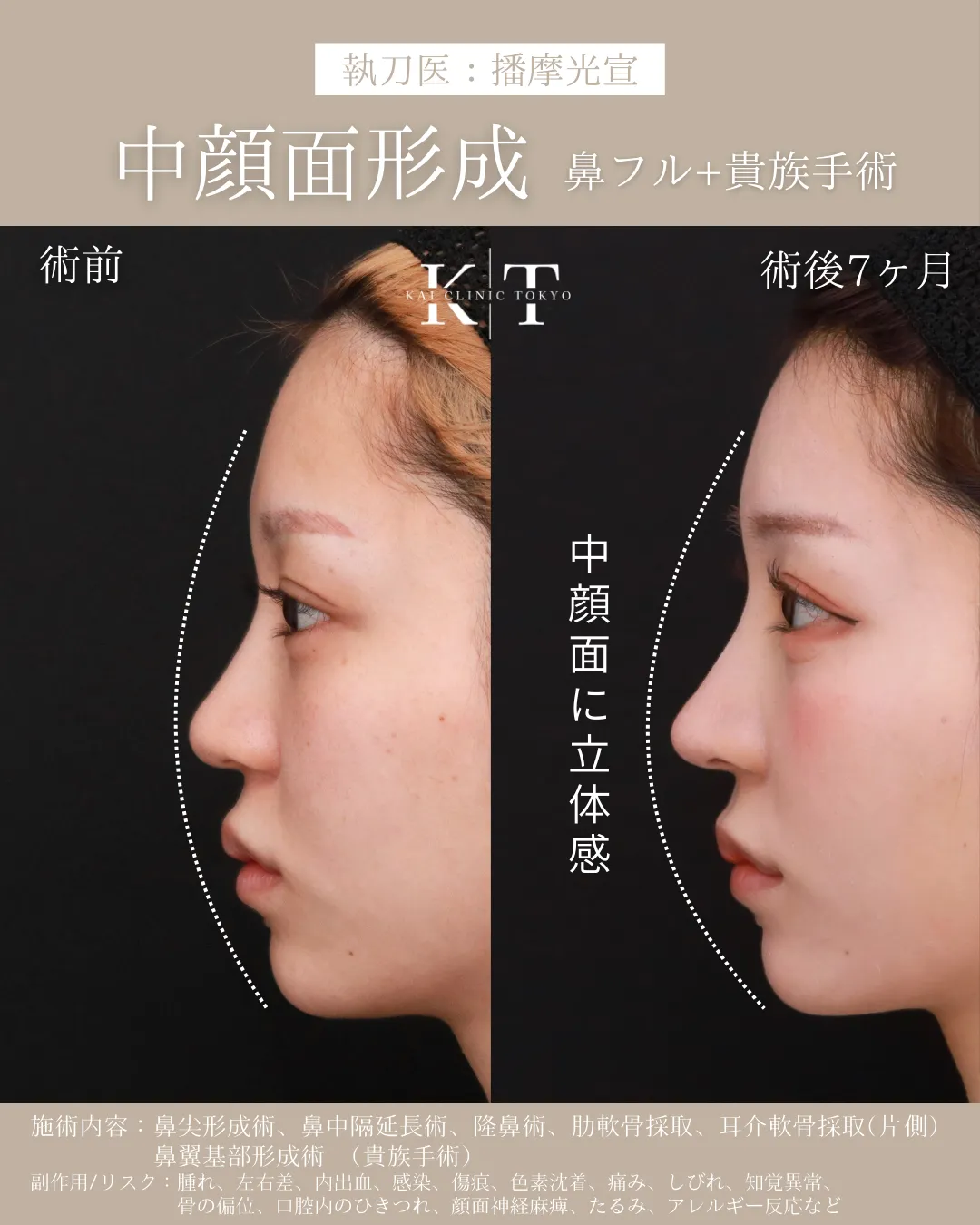 中顔面形成（鼻フル＋貴族手術）【20代女性】