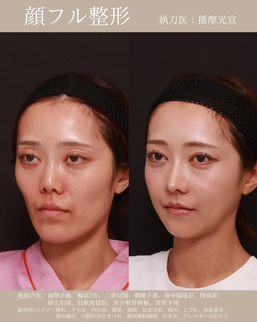 顔フル整形　骨切り　症例
