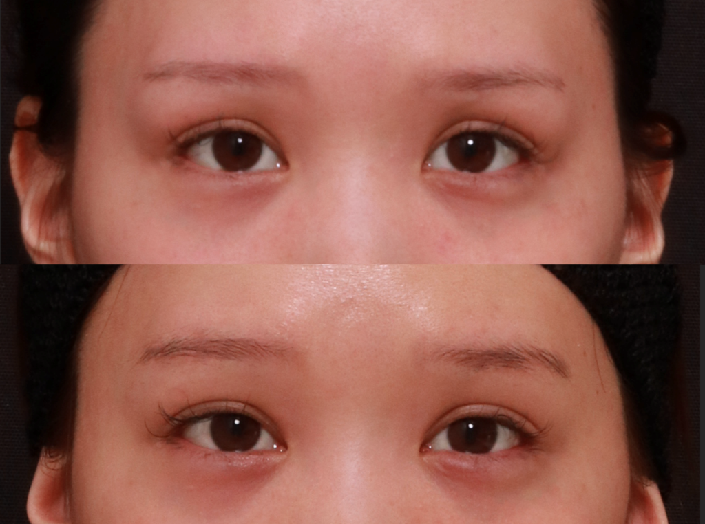 眉骨削り 症例