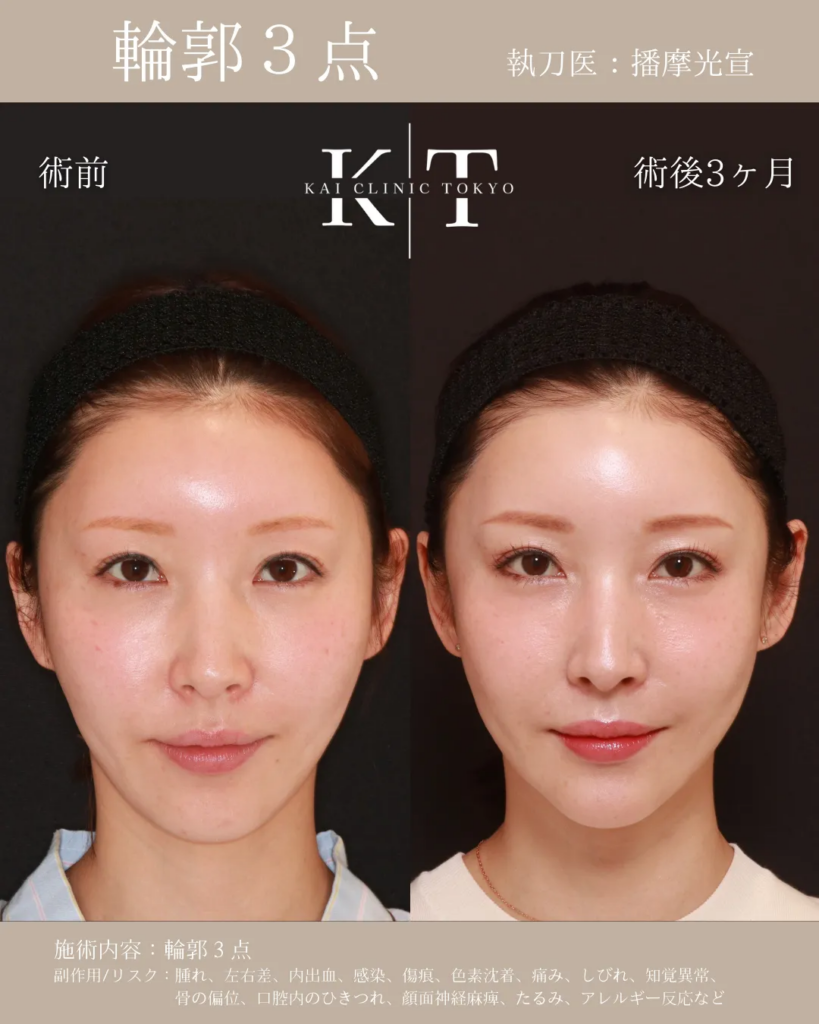 輪郭3点　整形　症例