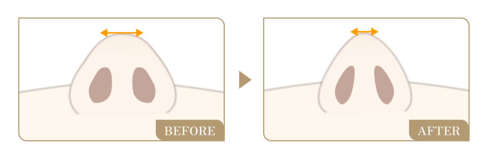 鼻先整形　鼻尖形成術