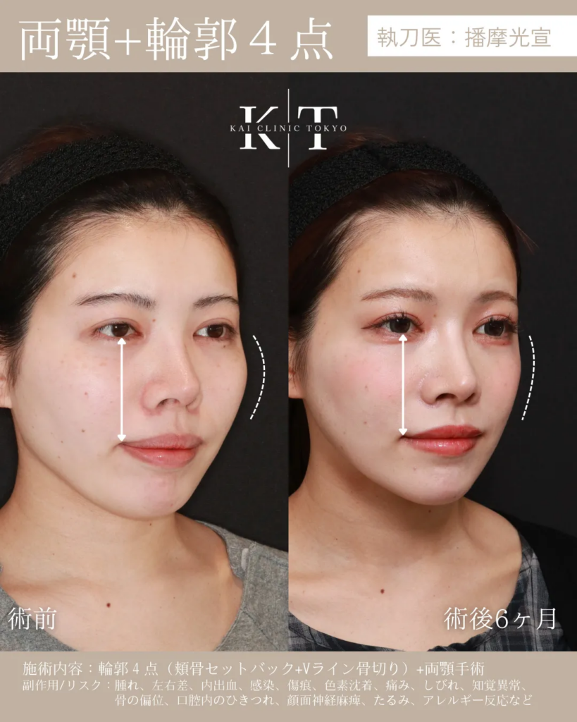 両顎　輪郭4点　症例