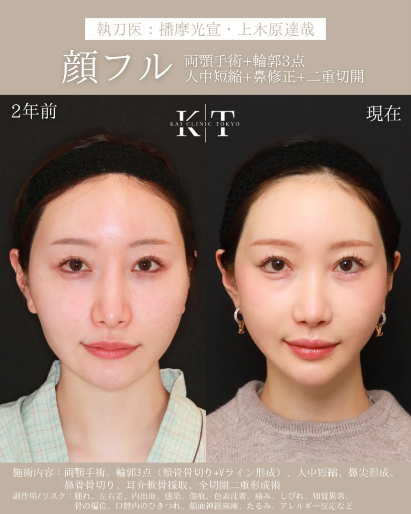 顔　フル整形　症例