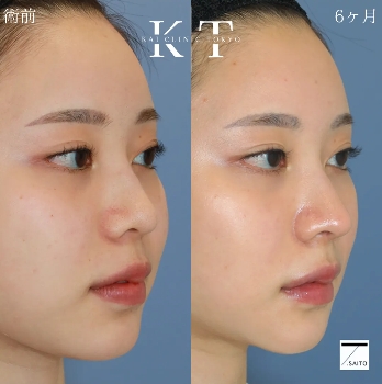 鼻先整形　鼻フル×輪郭