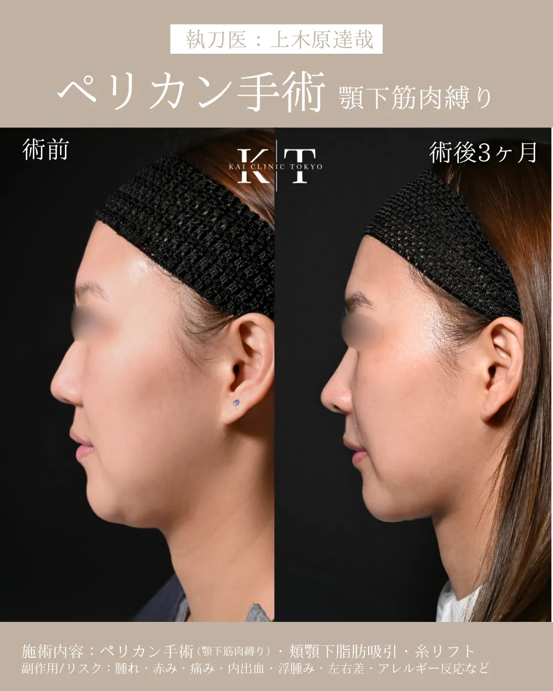 ペリカン手術【30代女性】