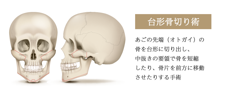 Genioplasty - Trapezoidal Osteotomy - What It Is