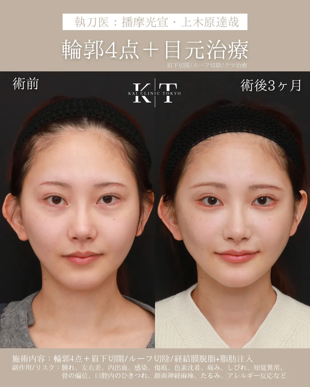 輪郭4点＋目元治療【20代女性】