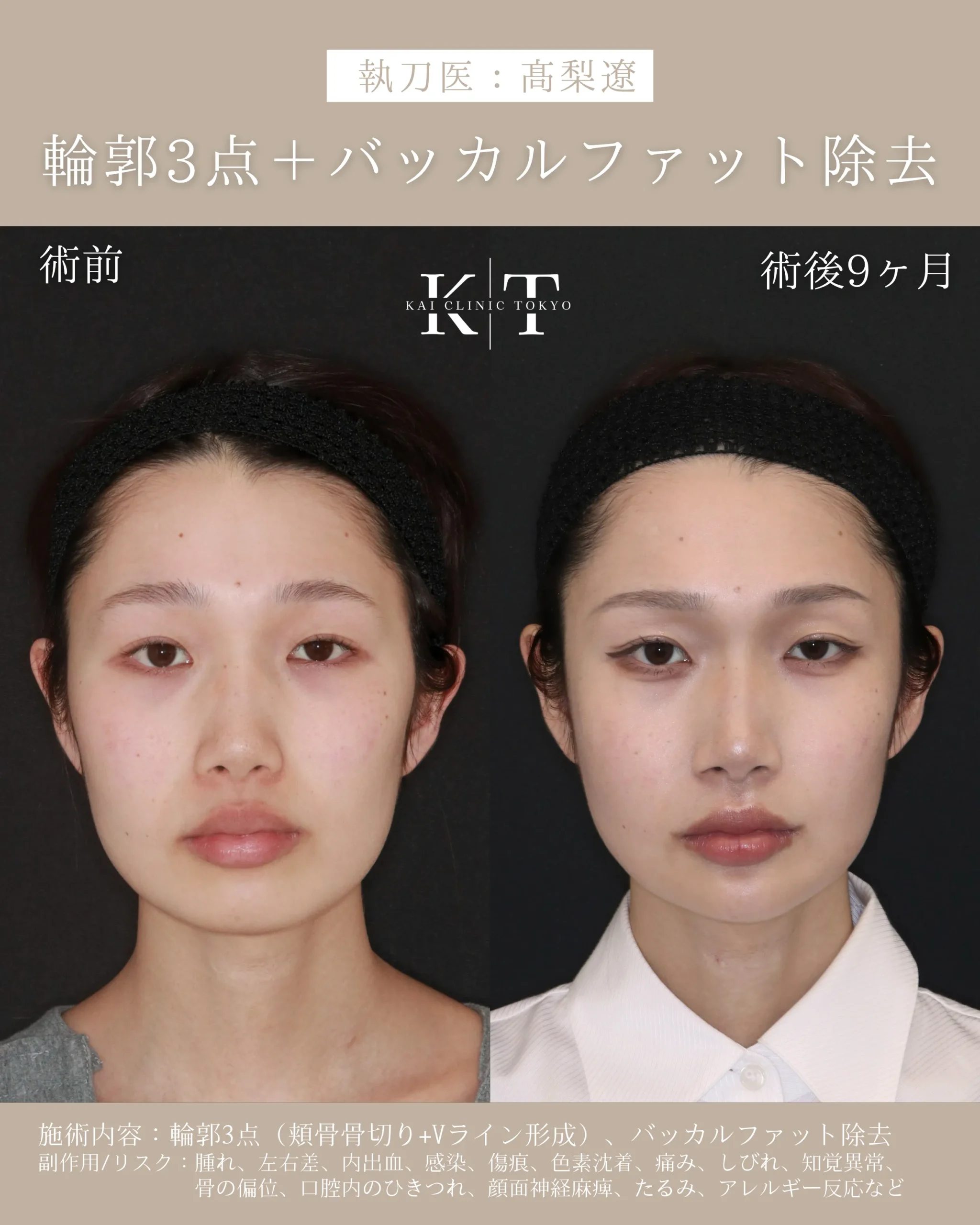 輪郭3点＋バッカルファット除去【20代女性】