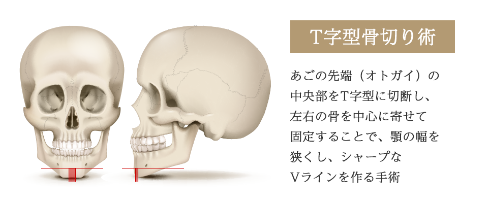 Genioplasty - What is T-Shape Osteotomy