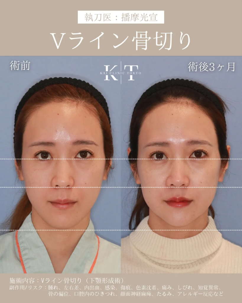 カイクリニック東京 Vライン 骨切り 症例