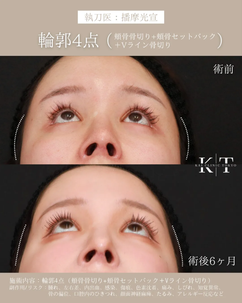 カイクリニック東京 頬骨セットバック 輪郭4点 症例