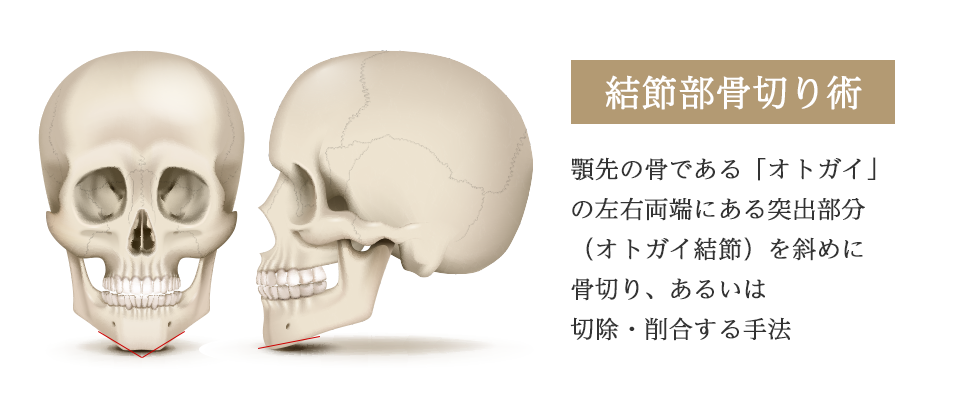 オトガイ形成 結節部骨切り術 とは