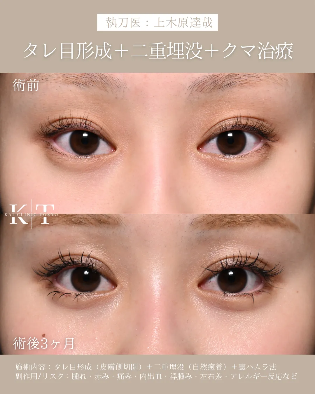 タレ目形成＋二重埋没＋クマ治療【20代女性】