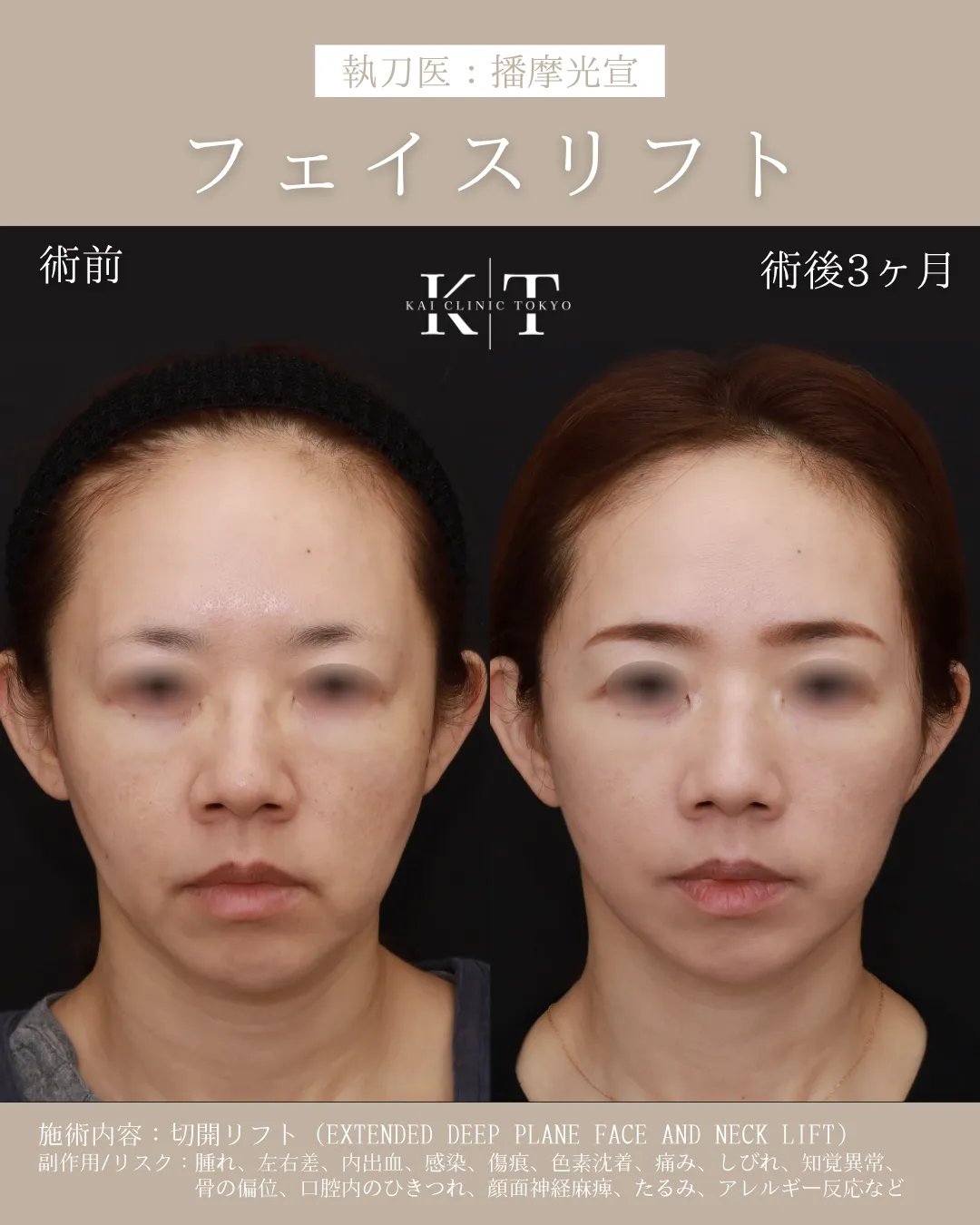 フェイスリフト【50代女性】