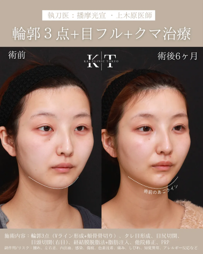 輪郭3点＋クマ治療　症例