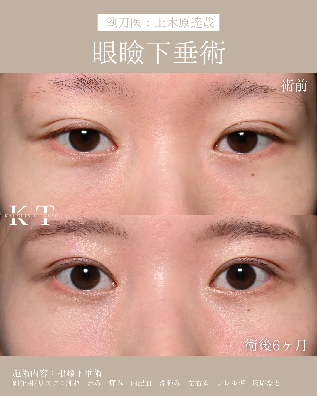 眼瞼下垂術【20代女性】