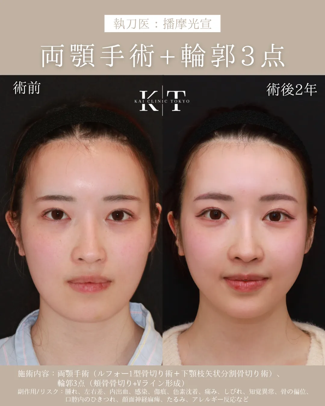 両顎手術＋輪郭3点【20代女性】