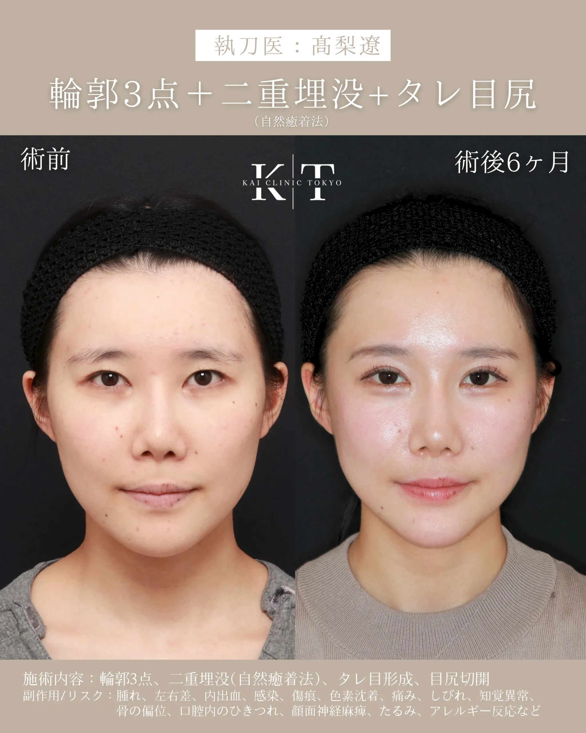 輪郭3点＋二重埋没＋タレ目尻【20代女性】