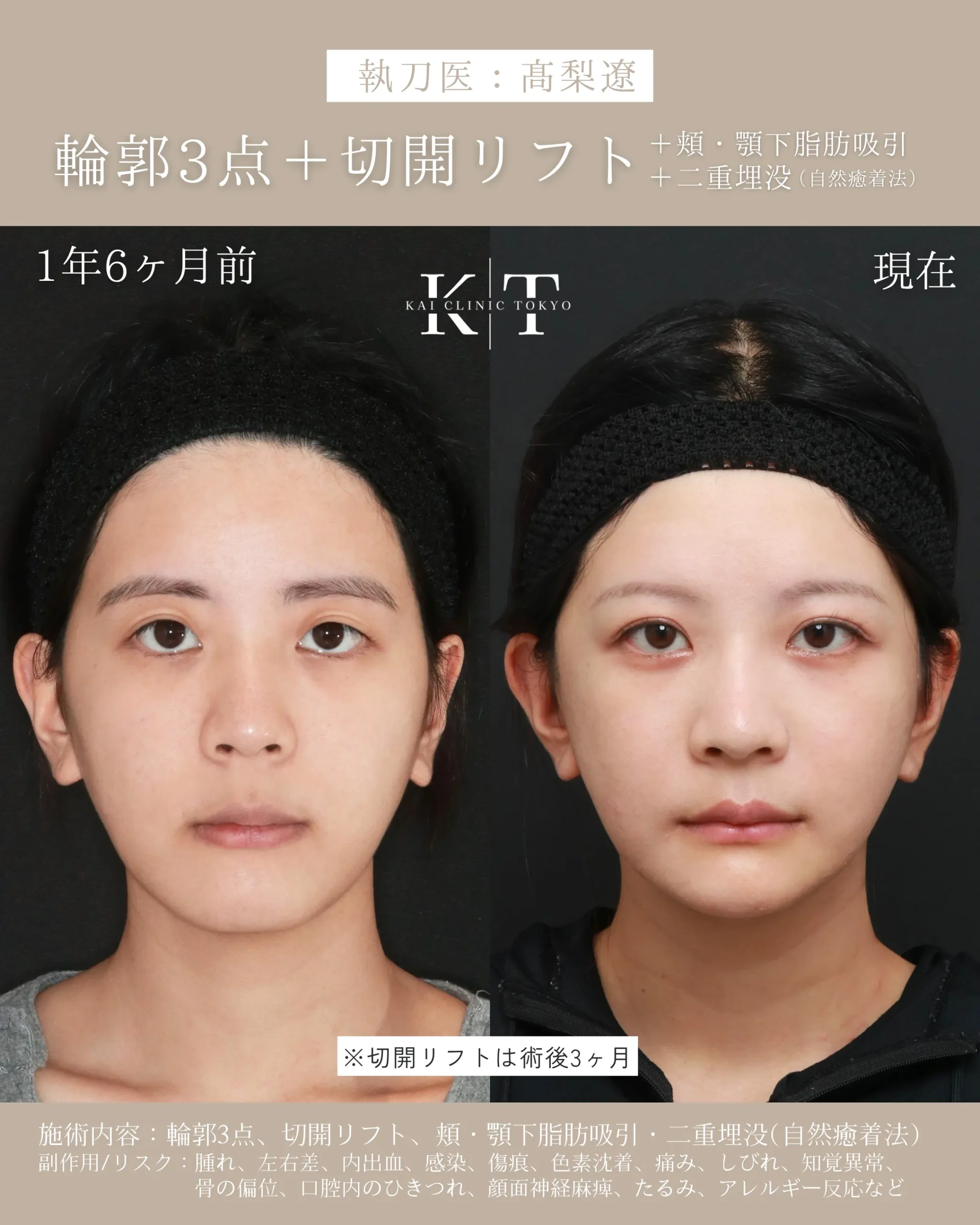 輪郭3点＋切開リフト＋脂肪吸引＋二重埋没【20代女性】