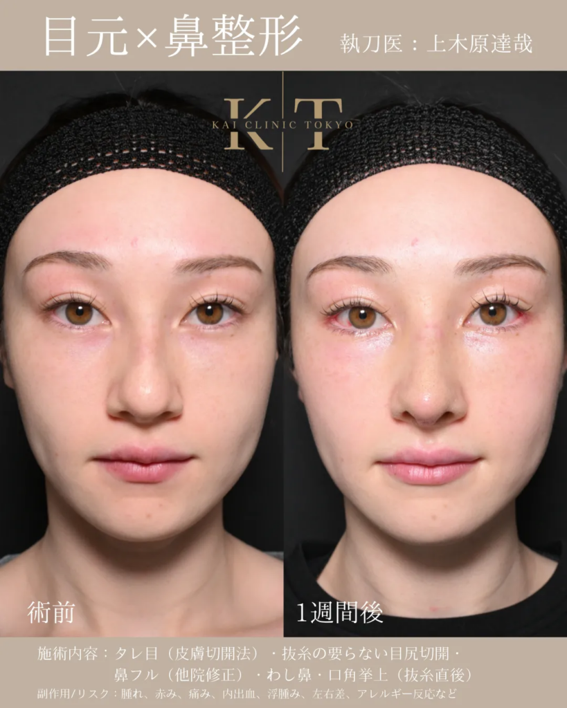 目元　鼻　整形　症例
