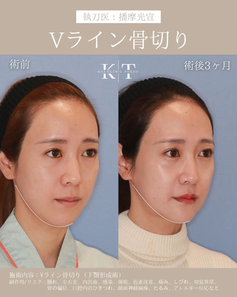 Vライン形成　症例　
