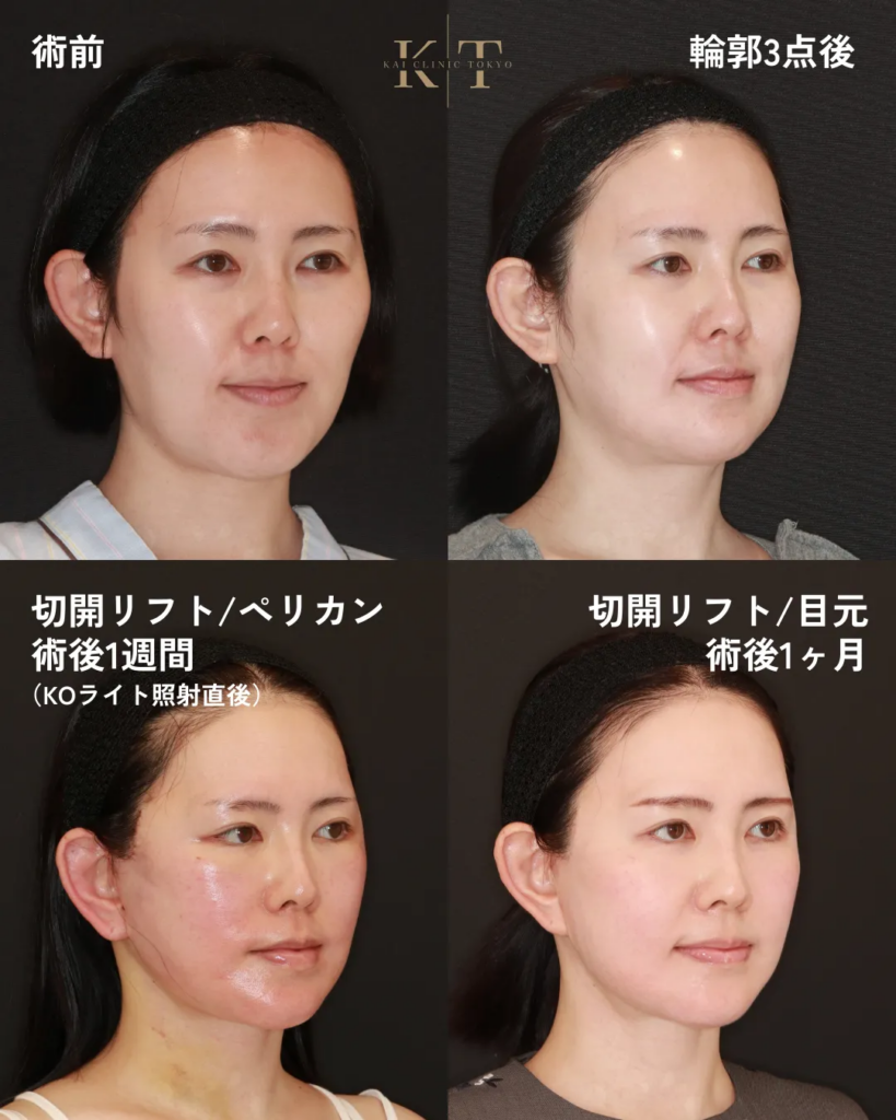輪郭　たるみ治療　症例