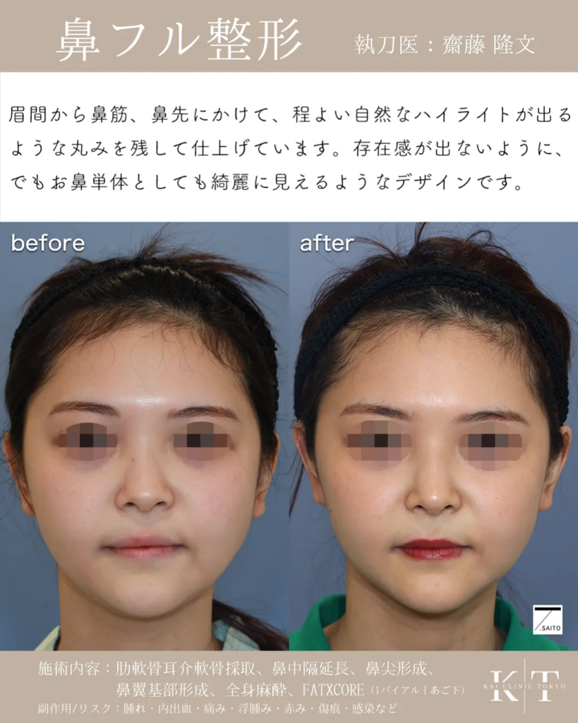 鼻フル 症例