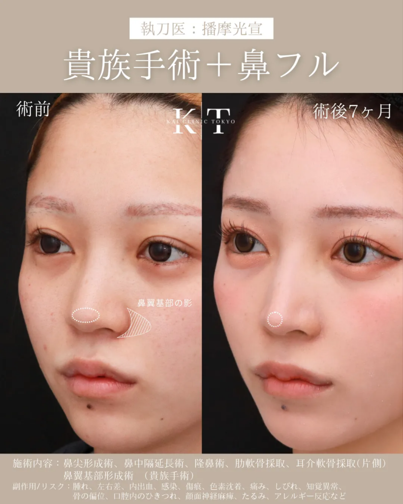 中顔面形成(鼻フル+貴族手術) 症例