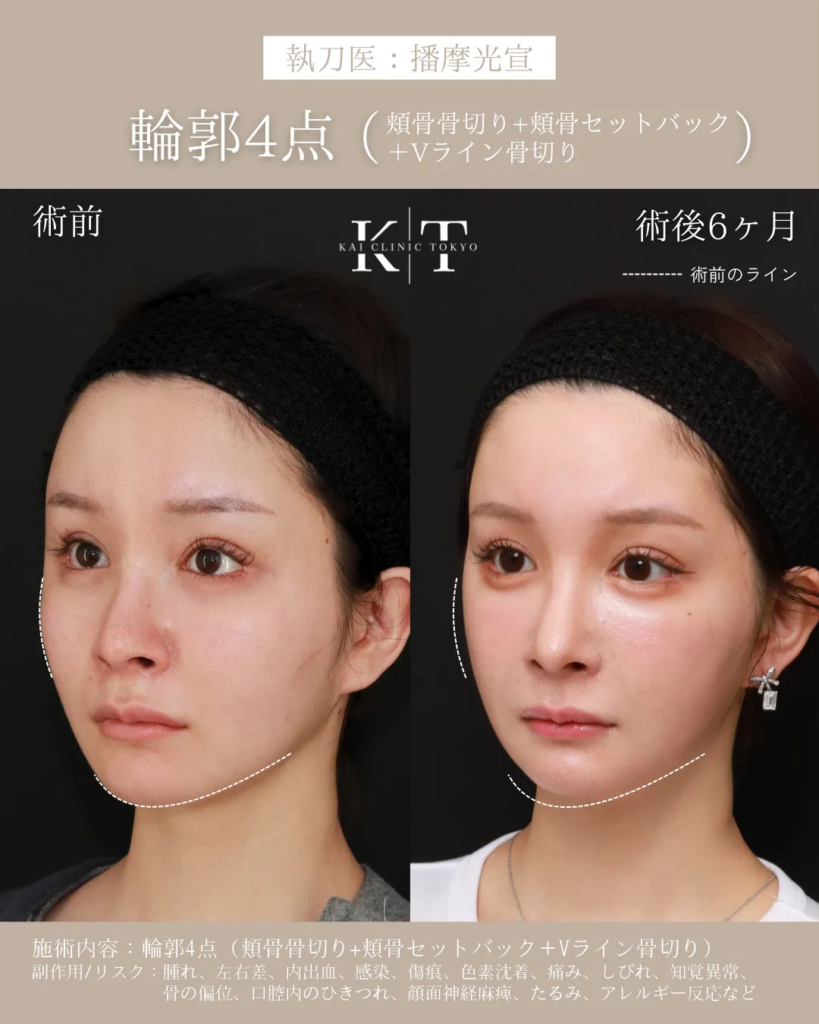 輪郭4点　頬骨セットバック＋Vライン形成　症例