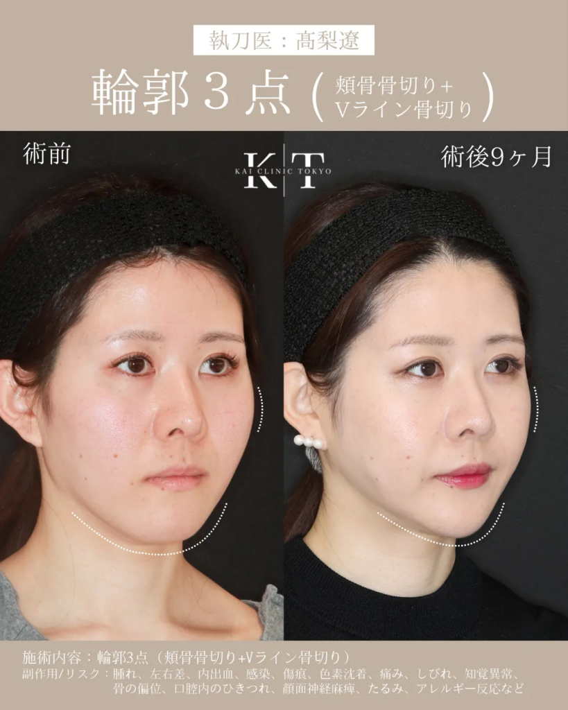 輪郭3点（頬骨骨切り+Vライン形成）　症例