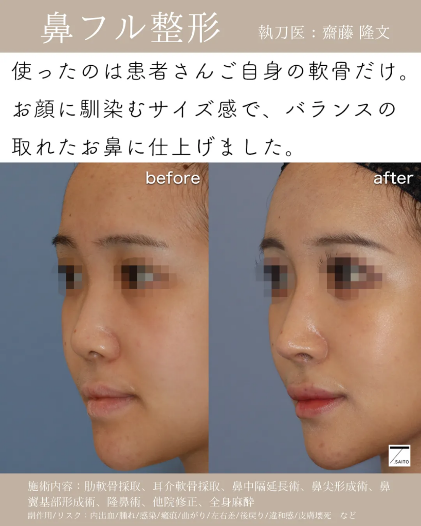 鼻フル整形　症例