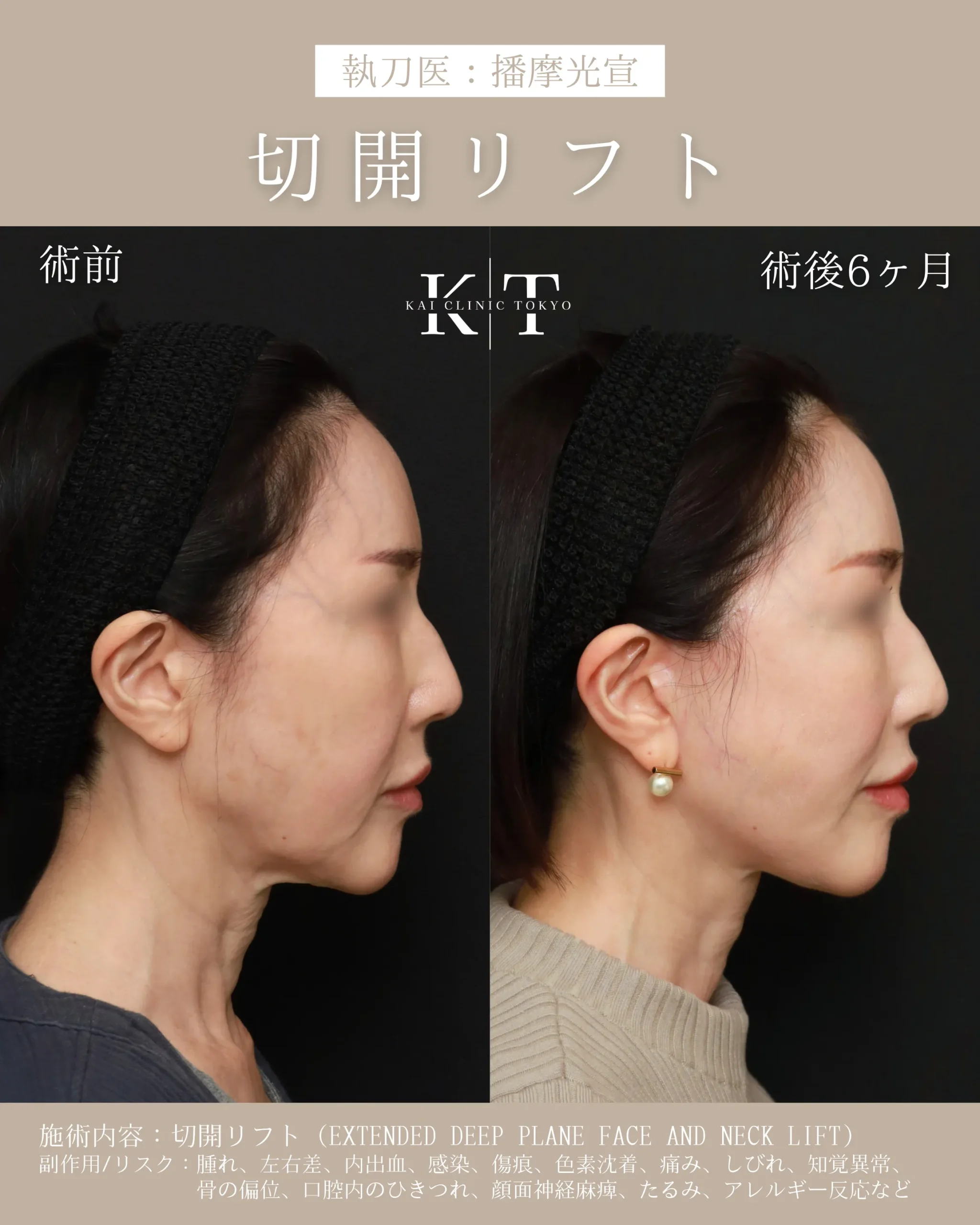 切開リフト【50代女性】