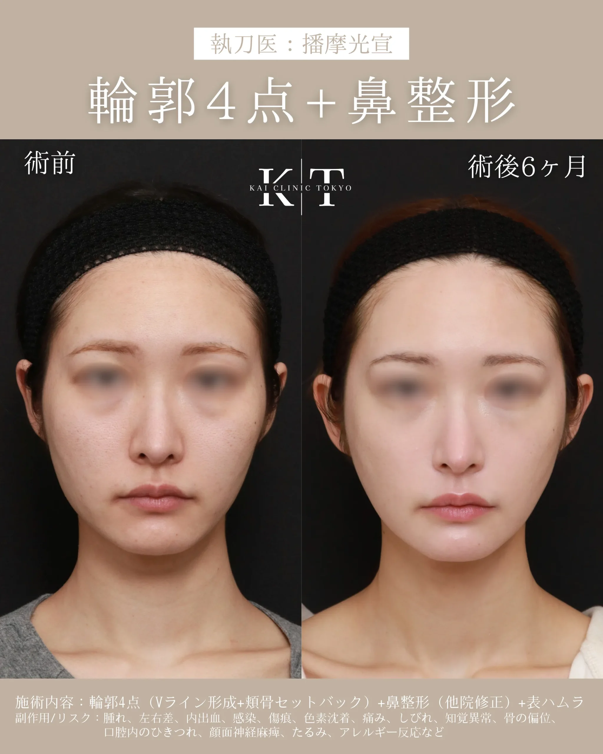 輪郭4点+鼻整形【20代女性】